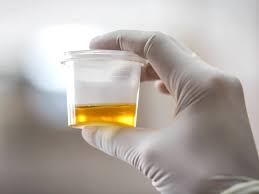 24 Hrs Urine Uric Acid