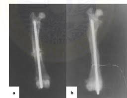 Alkaline Phosphatase with Bone Fraction