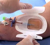 CATHETER SITE DRESSING