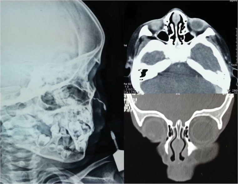 CT  Sinogram