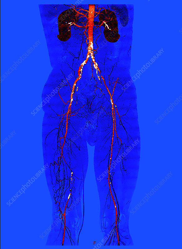 CT ANGIO - ABDOMINAL AORTA AND RUN OFF VESSEL