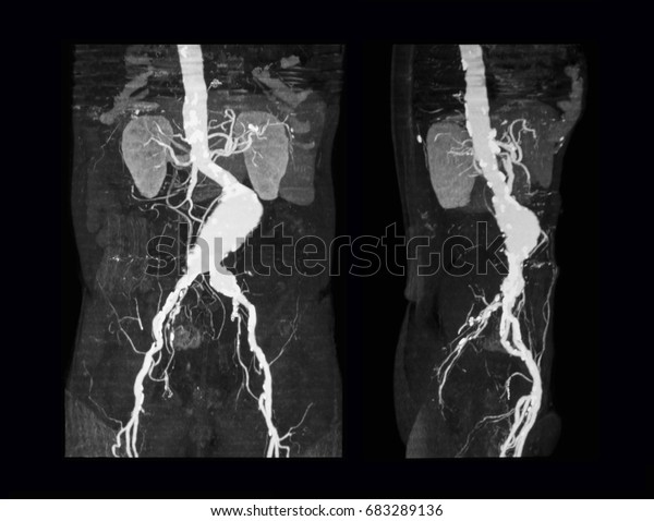 CT ANGIO - ABDOMINAL AORTA AND RUN OFF VESSEL