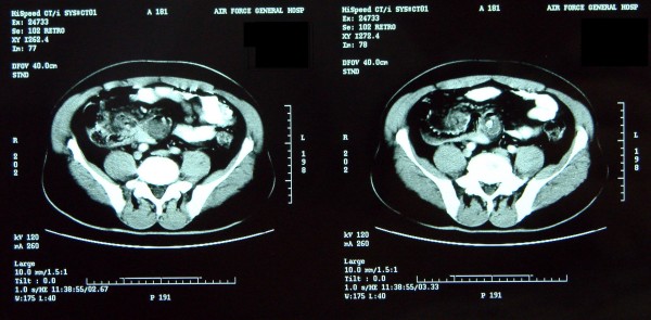 CT Abdomen Male