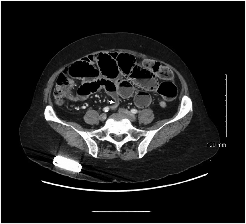 CT Abdomen and Pelvis - Specialized Procedure