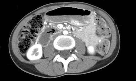 CT Abdomen and Pelvis Female)