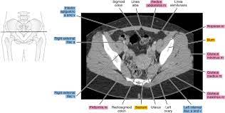 CT Abdomen and Pelvis Female