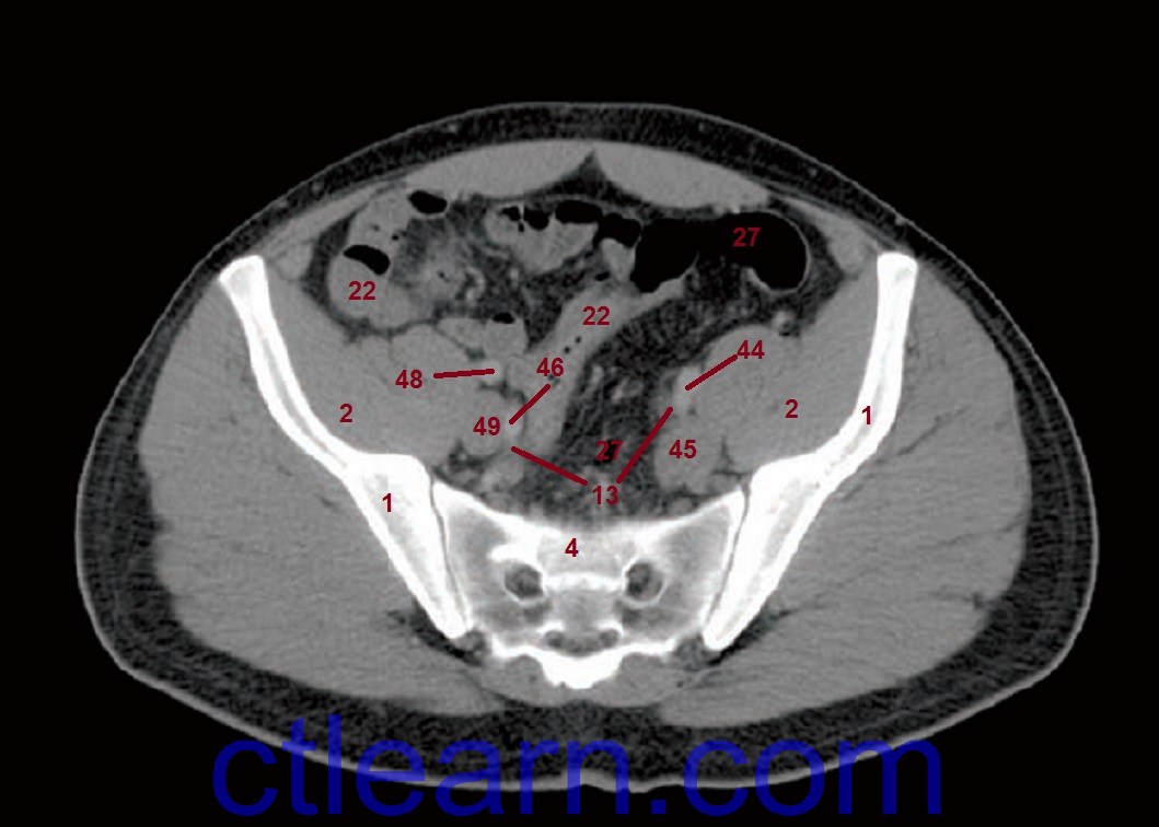 CT Abdomen and Pelvis Male