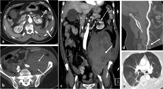 CT Angio Abdomen & Pelvis