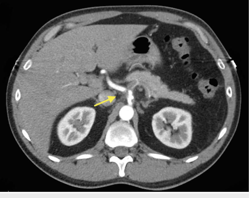 CT Angio Abdomen & Pelvis