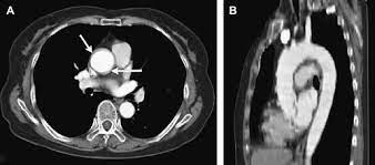 CT Angiogram Aorta