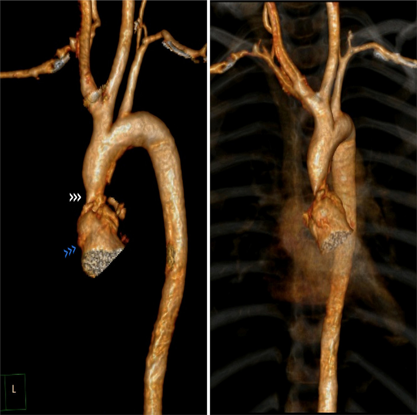 CT Angiogram Aorta