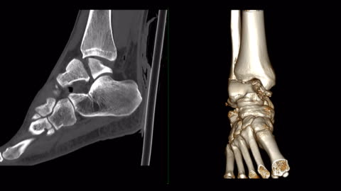 CT Ankle Joint