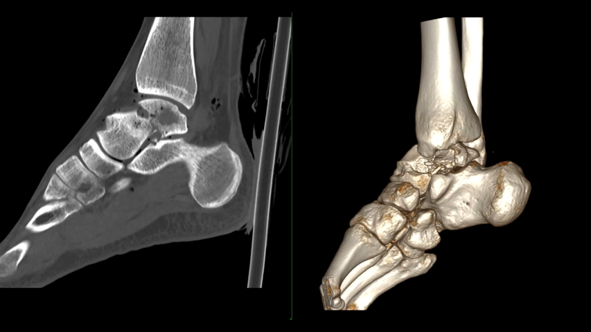 CT Ankle Joint