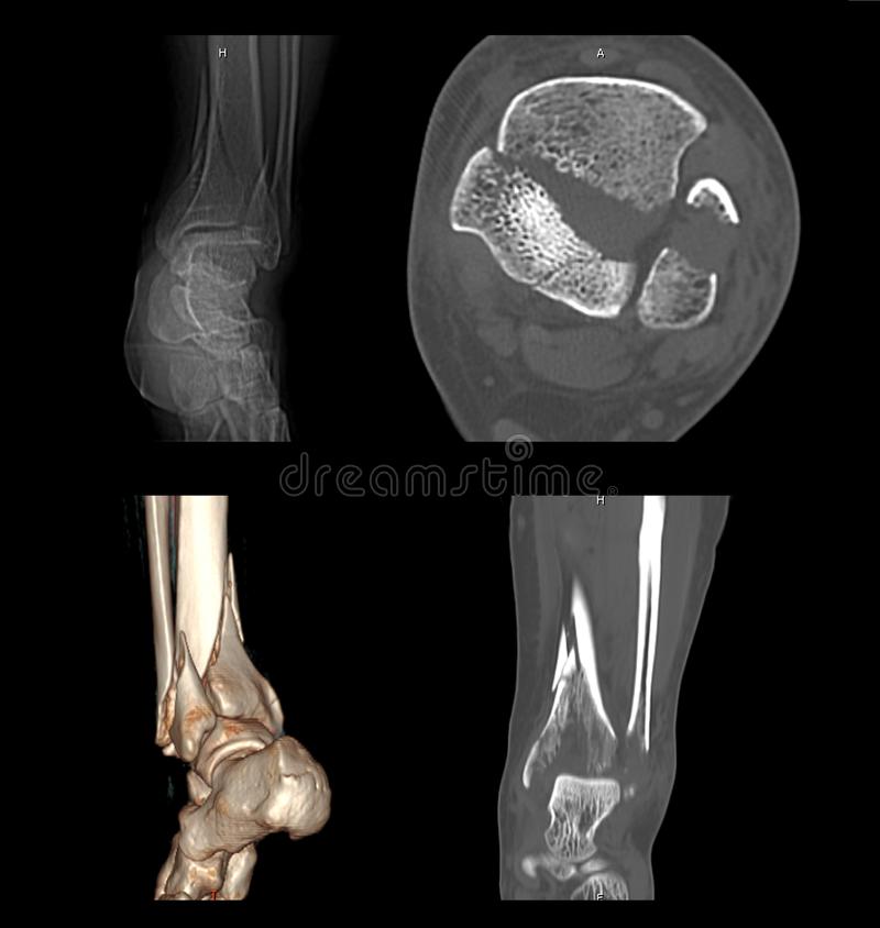 CT Ankle Joint Left