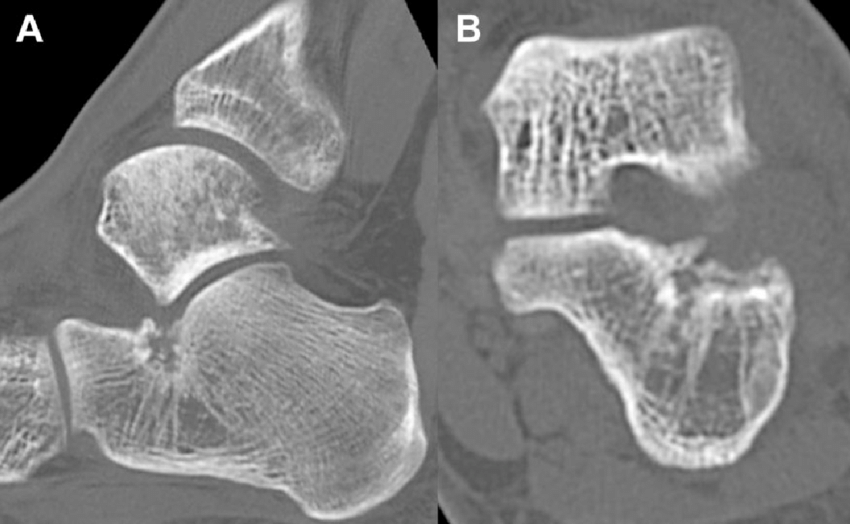 CT Ankle Joint Left