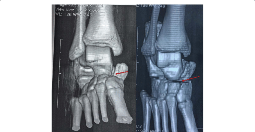 CT Ankle Joint Right