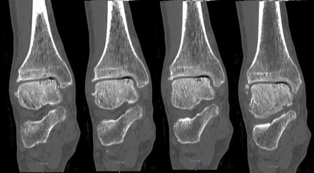 CT Ankle Joint Right