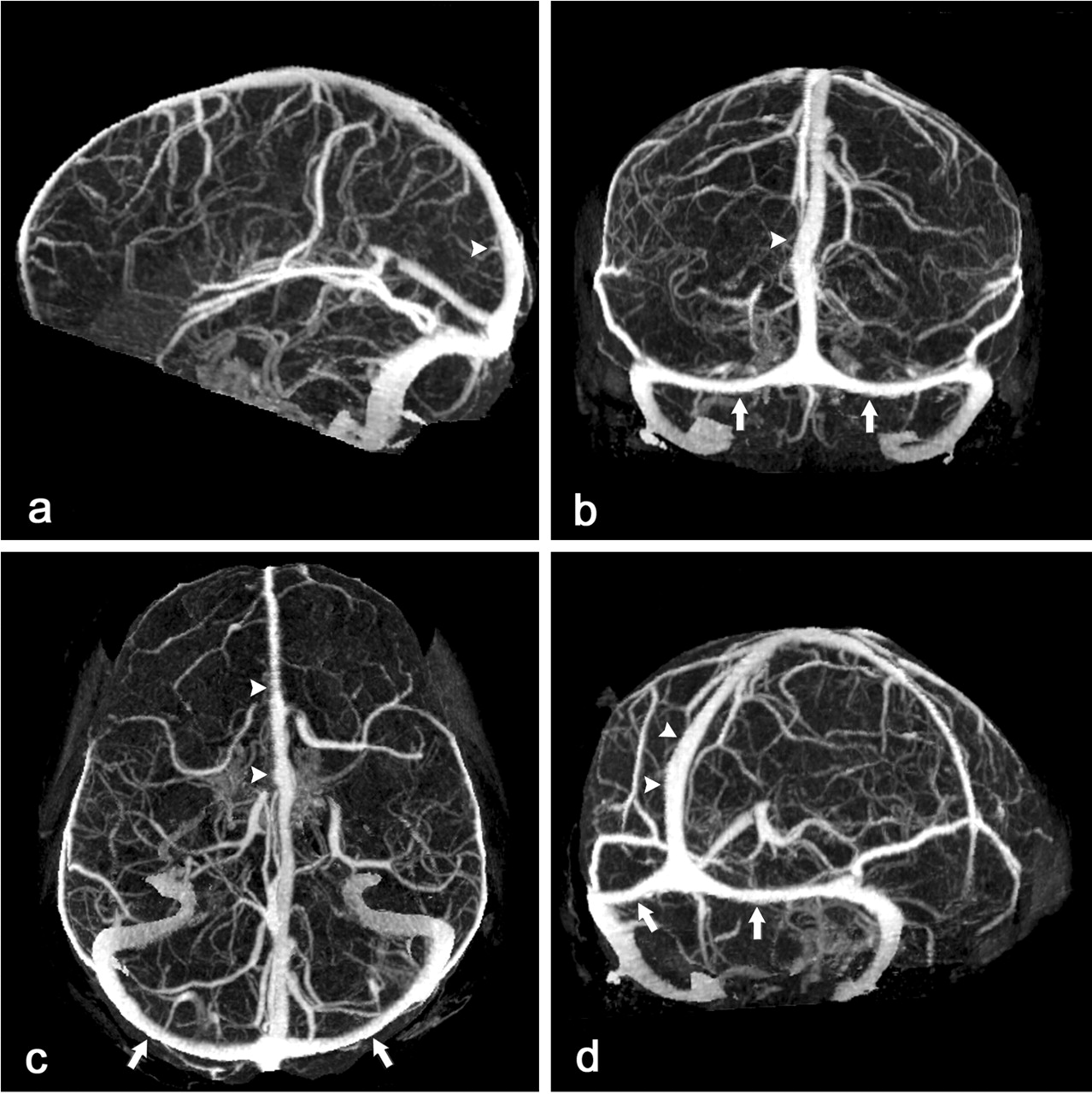 CT BRAIN + ANGIO + VENOGRAPHY