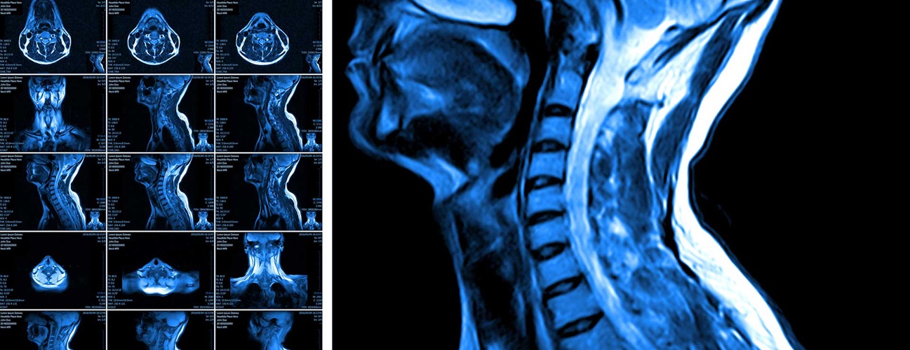 CT BRAIN + CERVICAL SPINE