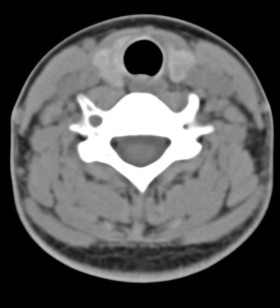 CT BRAIN + CERVICAL SPINE