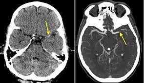 CT BRAIN ANGIOGRAPHY