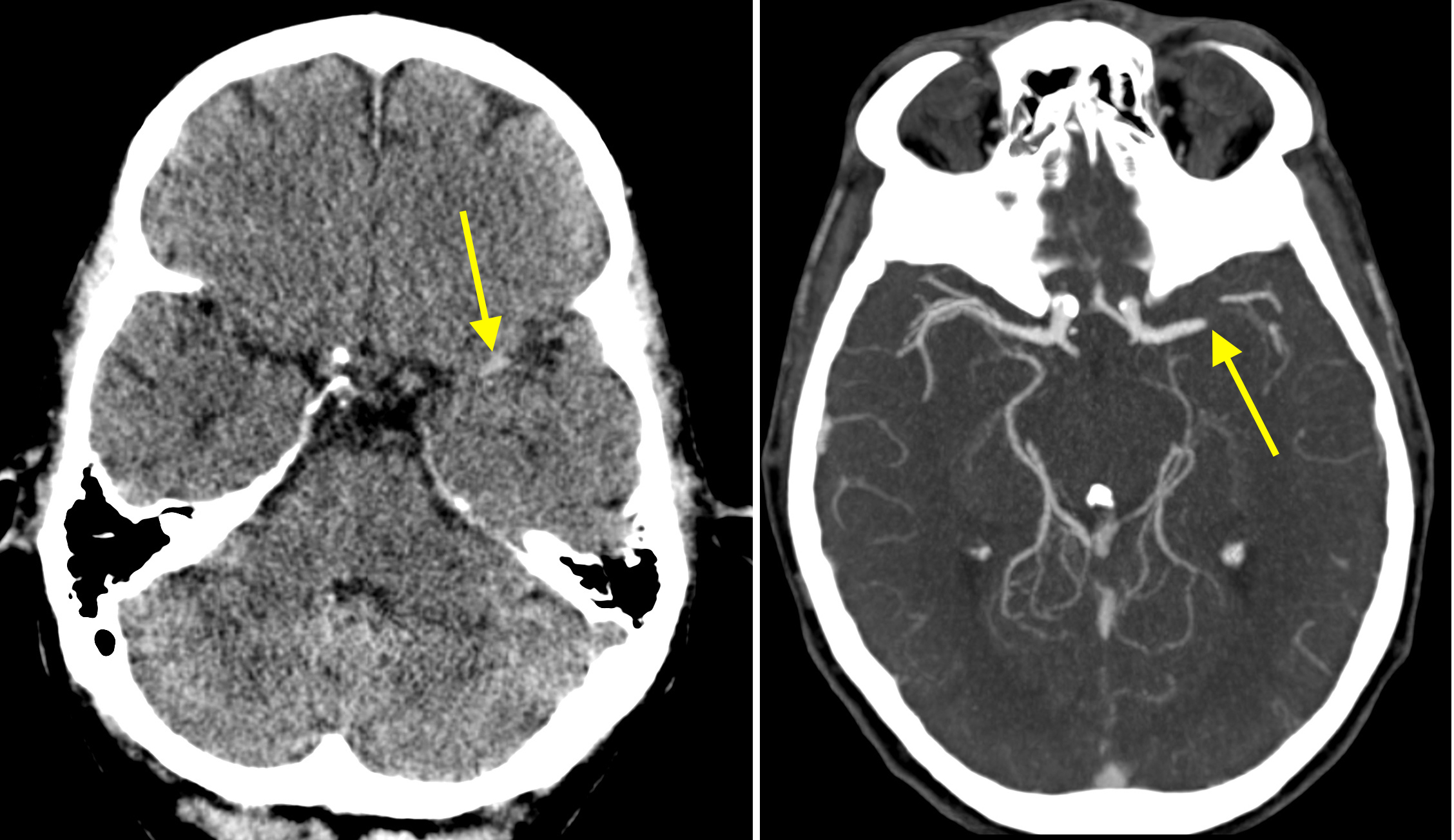 CT BRAIN ANGIOGRAPHY