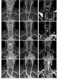 CT Brain + Carotid Angiography