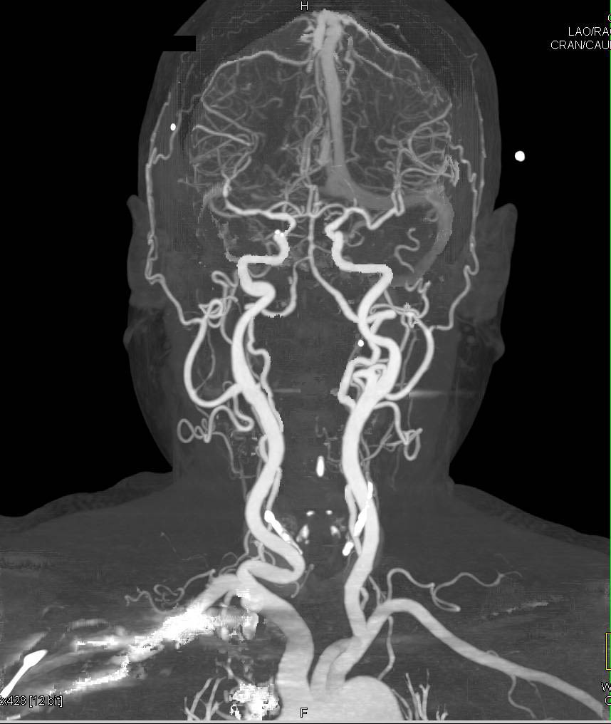 CT Brain + Carotid Angiography