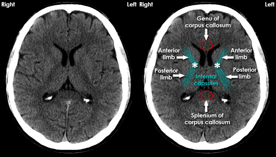 CT Brain