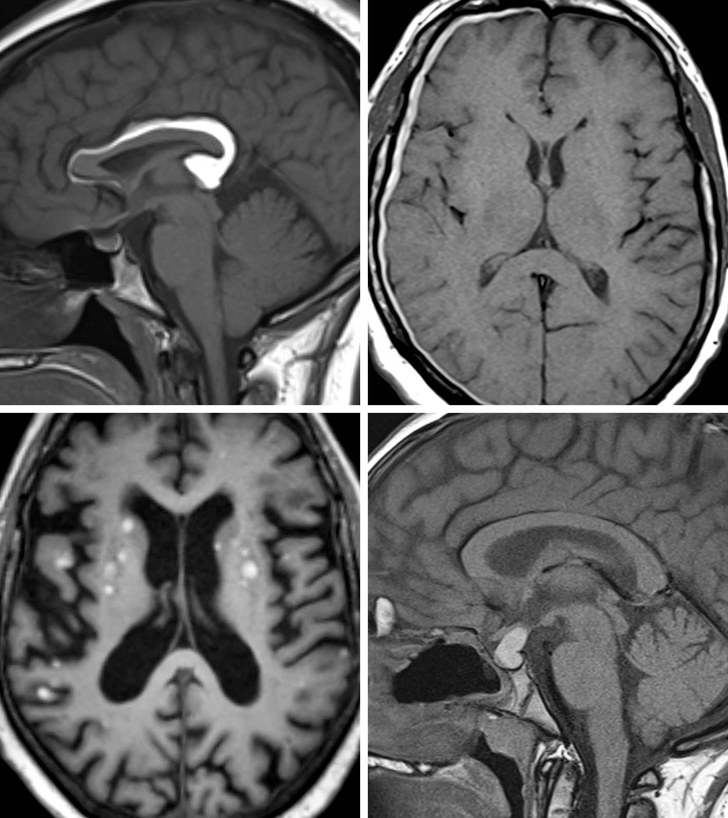 CT Brain With Sella (Plain)