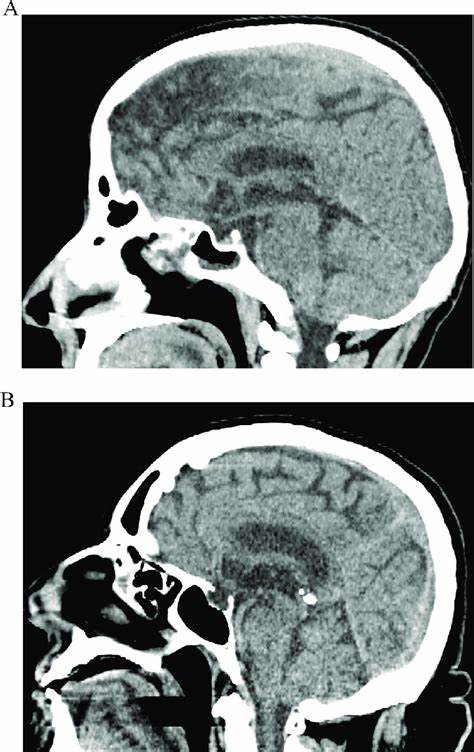 CT Brain With Sella (Plain)