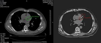 CT-CALCIUM SCORING