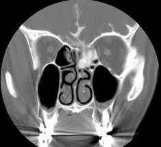 CT CISTERNOGRAPHY