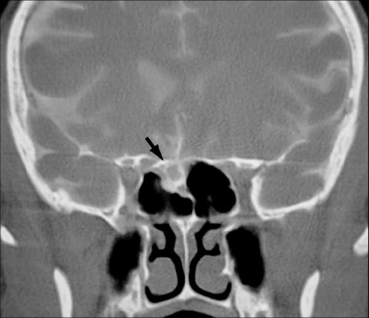 CT CISTERNOGRAPHY