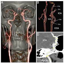 CT Carotid Angiography