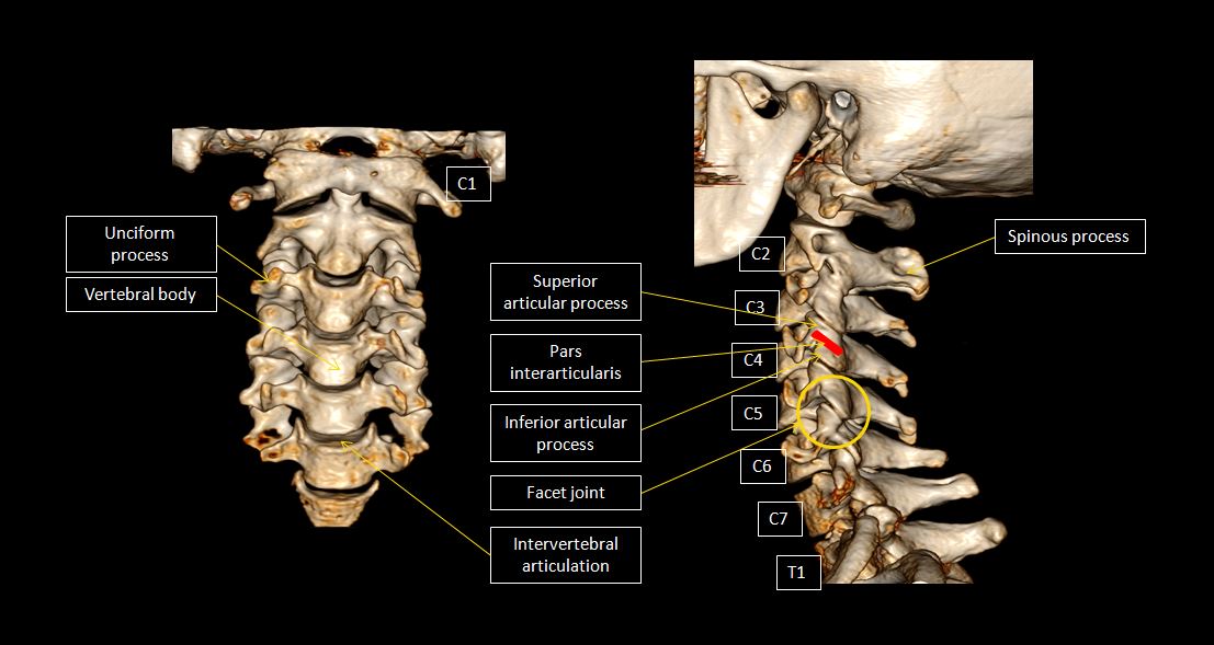 CT Cervical Spine