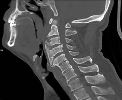 CT Cervical Spine