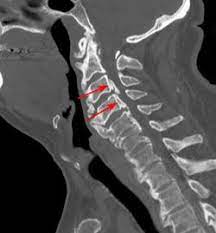 CT Cervicodorsal Spine