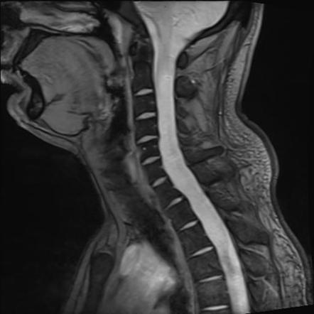 CT Cervicodorsal Spine