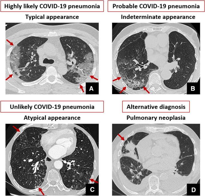 CT Chest