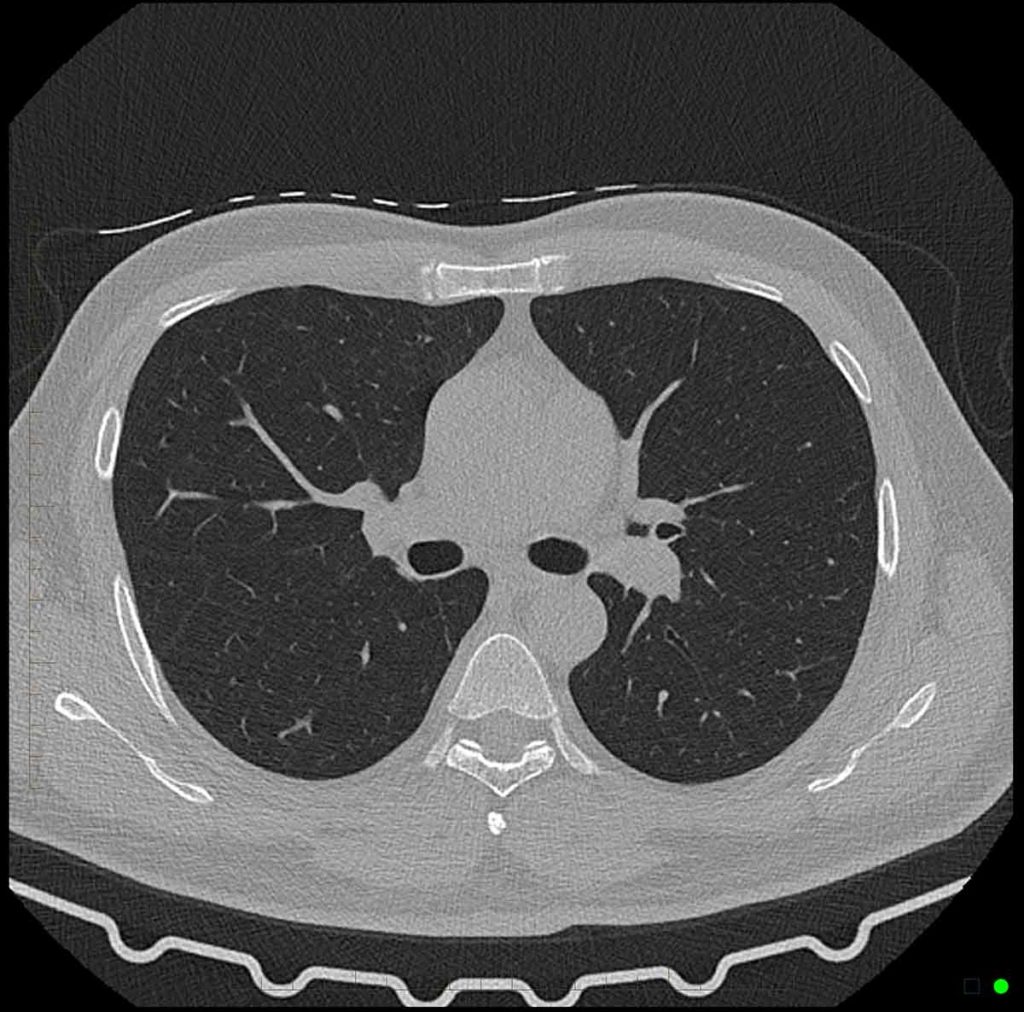 CT Chest