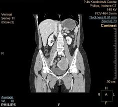 CT Chest / Abdomen and Pelvis