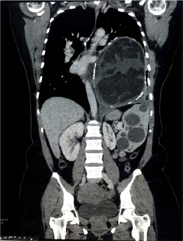 CT Chest / Abdomen and Pelvis