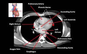 CT Chest / Thorax