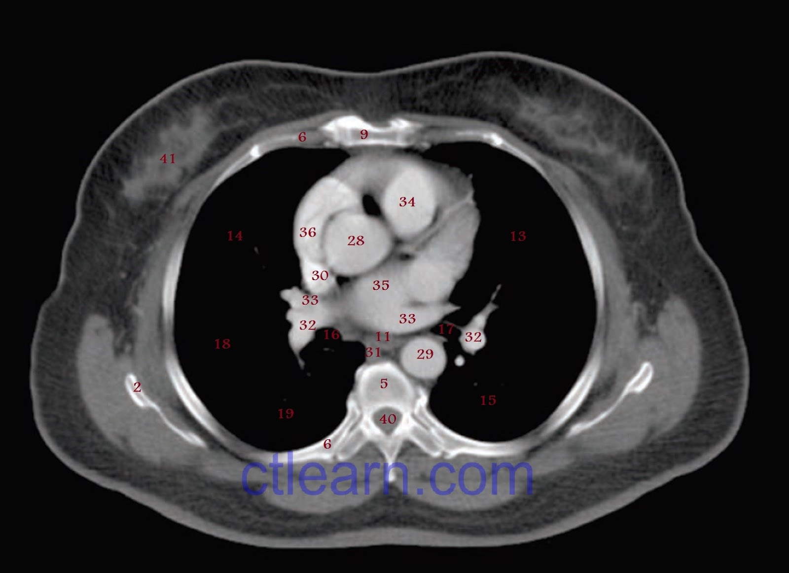 CT Chest / Thorax