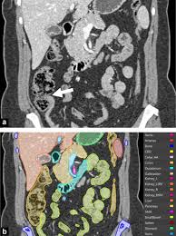 CT Chest with Abdomen