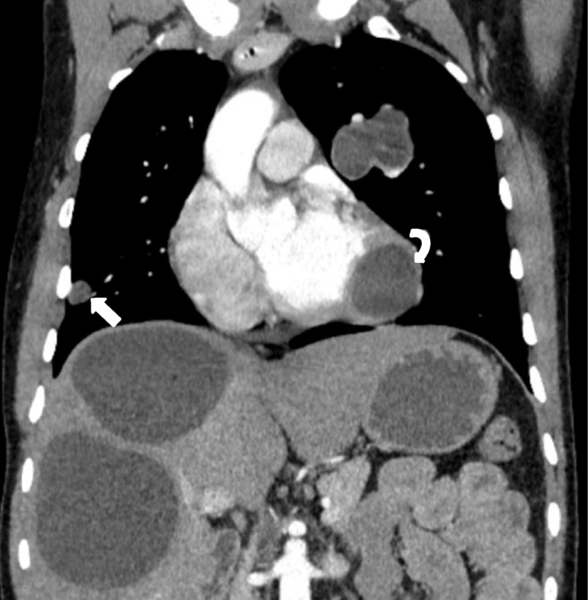 CT Chest with Abdomen