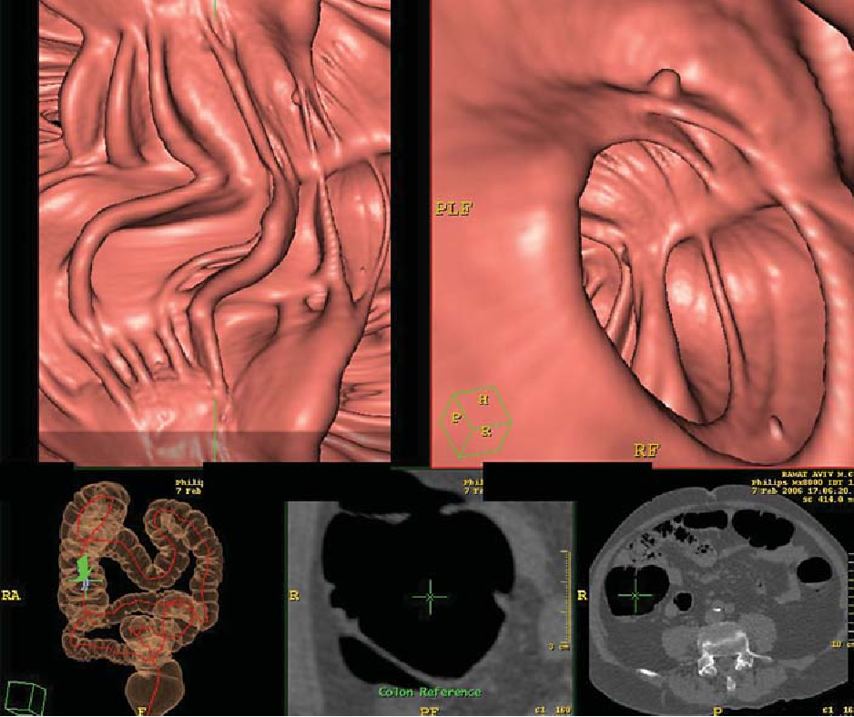 CT Colonography (Virtual Colonoscopy)