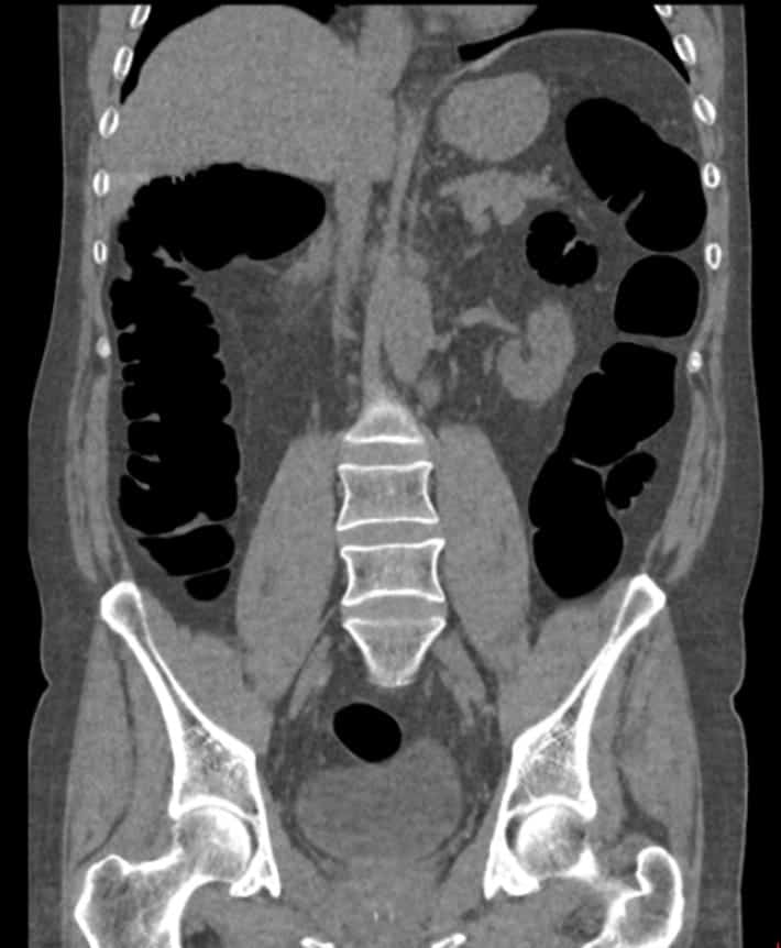 CT Colonography (Virtual Colonoscopy)