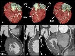 CT Coronary